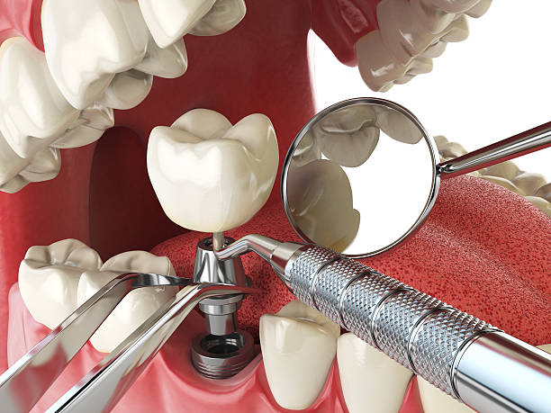 Best Root Canal Emergency Dentist  in Yosemite Valley, CA